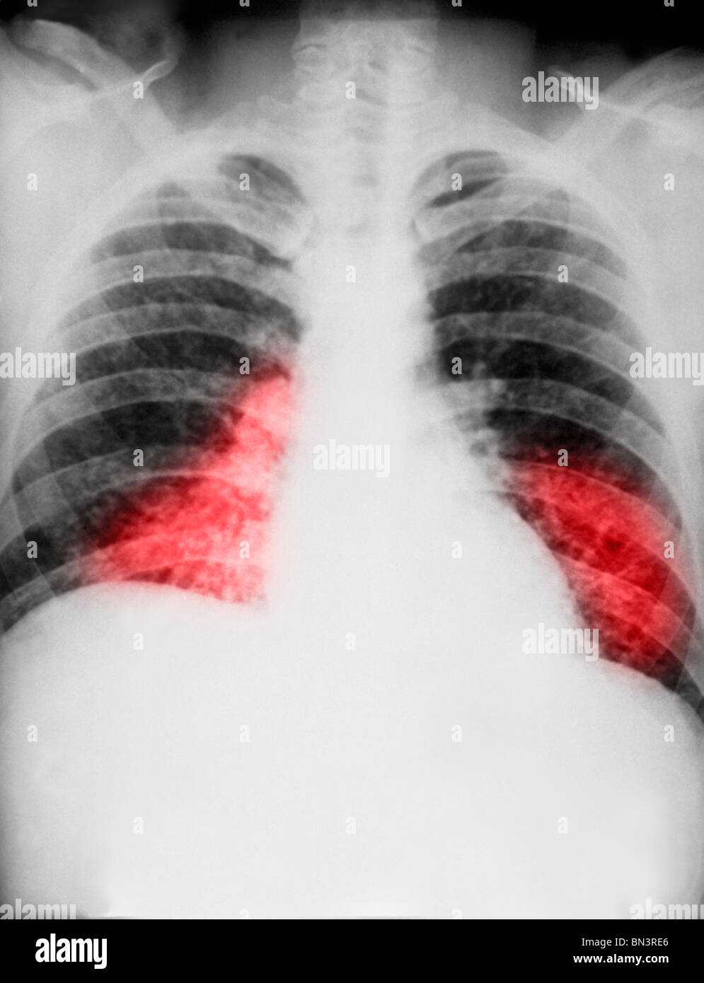 Brust Röntgen zeigt Histoplasmose Pilzinfektion Stockfoto