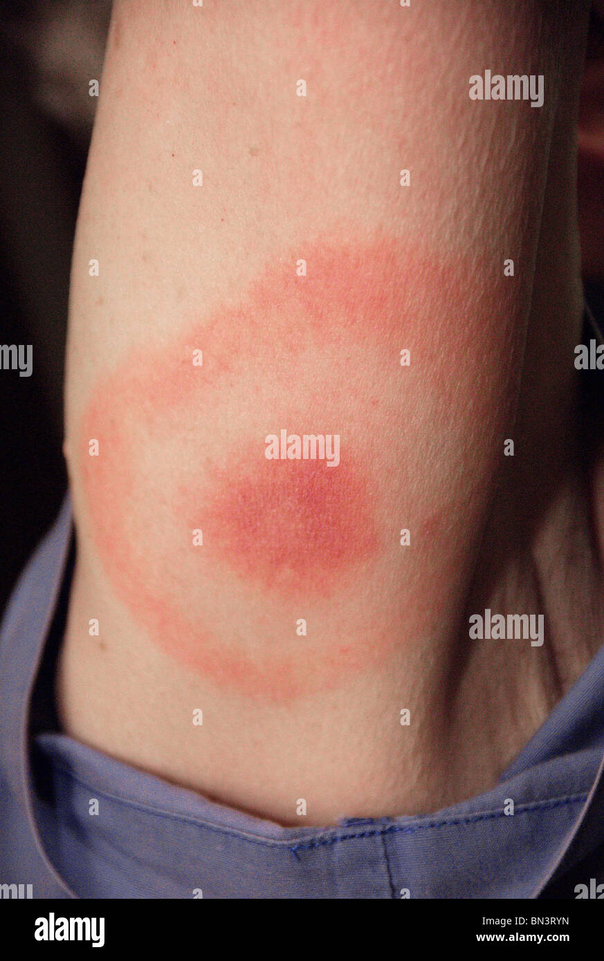 Nahaufnahme von pathognomonische erythematöse Ausschlag der Lyme Krankheit in das Muster ein "Volltreffer" Stockfoto