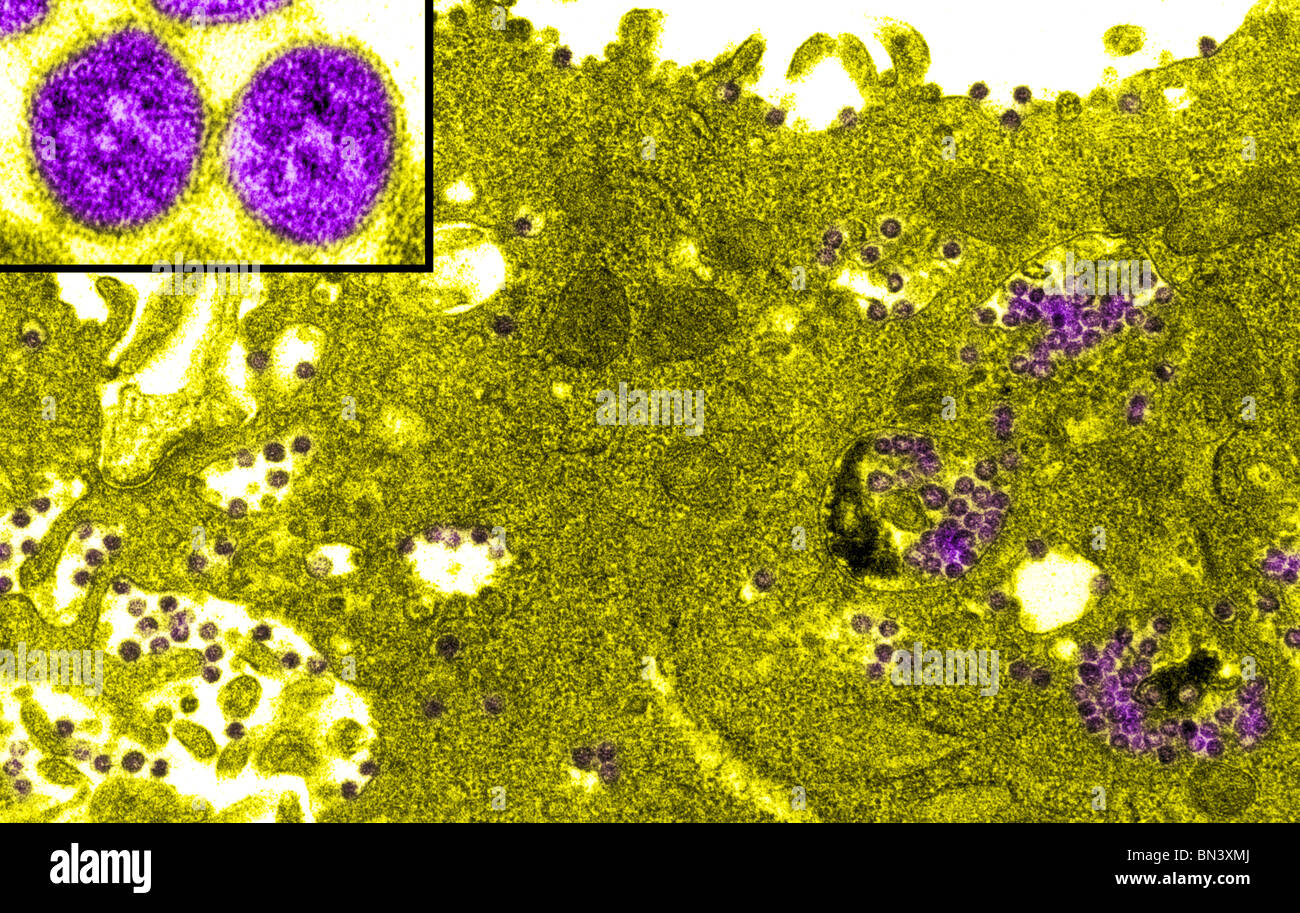 Transmission Electron Schliffbild einer infizierten Vero E6-Zelle mit Partikeln des Coronavirus, die Ursache der 2003 SARS Stockfoto