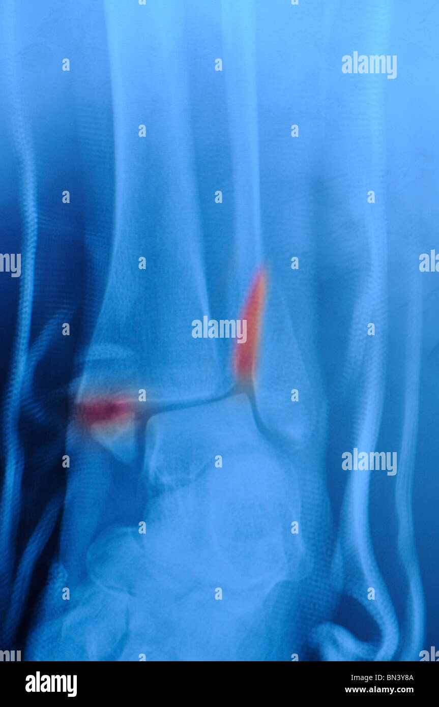 Bimalleolar Knöchel Bruch in eine Glasfaser-Schiene Stockfoto