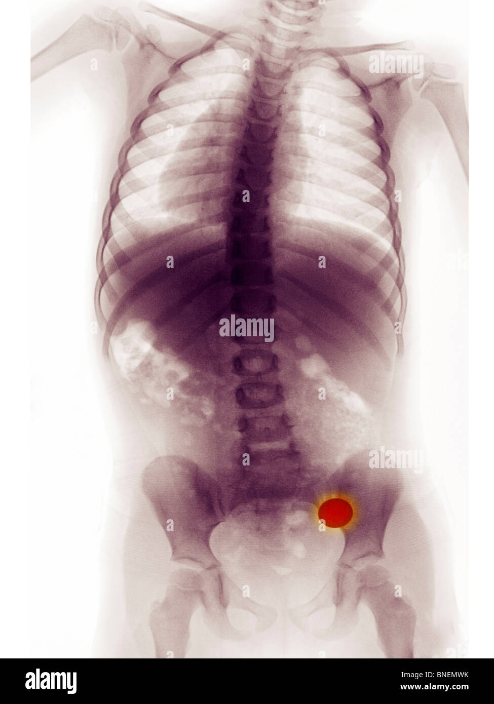 Bauch x-ray ein 3 Jahre altes Mädchen, das eine Münze verschluckt Stockfoto