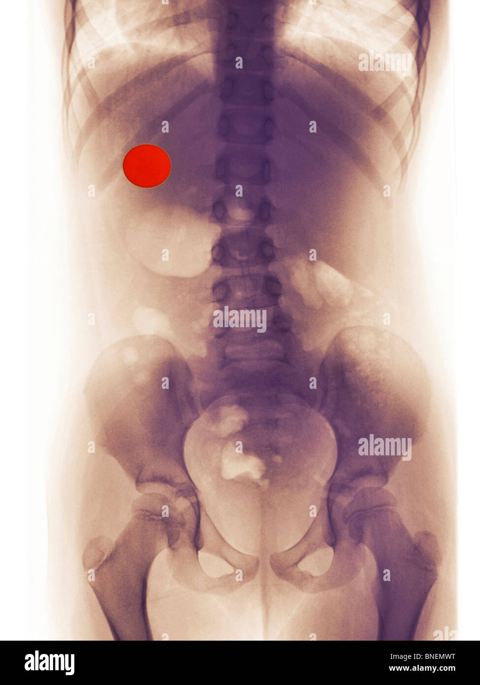 Bauch-x-ray eines 7-jährigen Mädchens, eine Viertel geschluckt Stockfoto