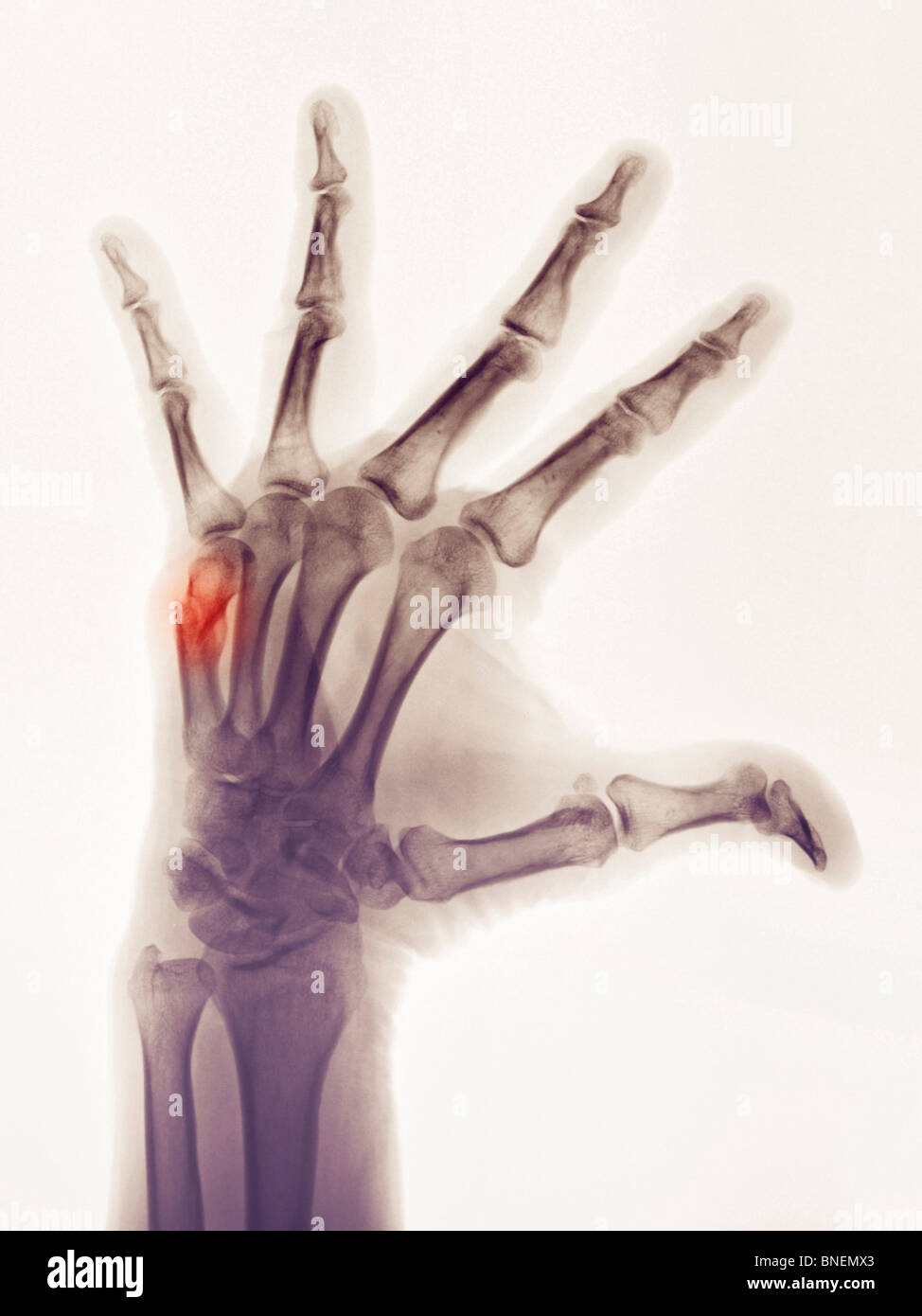 X-ray zeigt ein Boxer Fraktur in ein 57 Jahre alter Mann die Hand Stockfoto