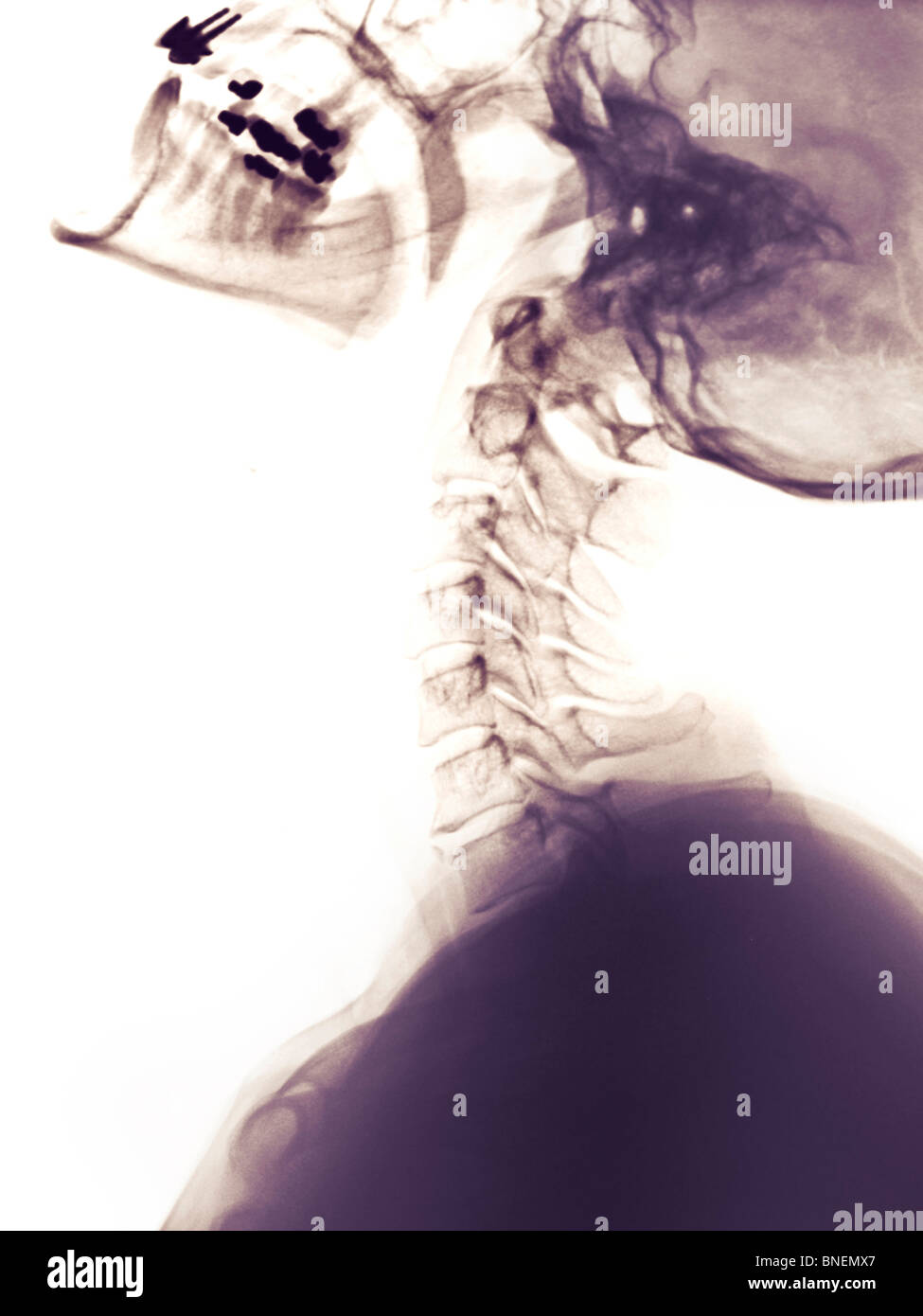 Halswirbelsäule Röntgen zeigt den Halswirbel in Verlängerung Stockfoto