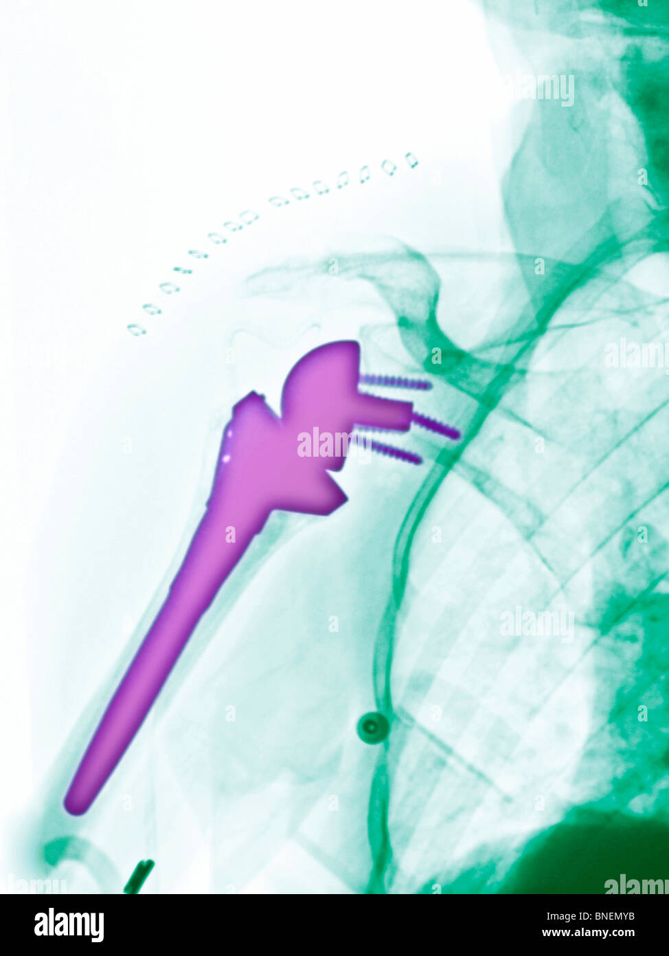 x-ray zeigt einen Schulter-Ersatz Stockfoto