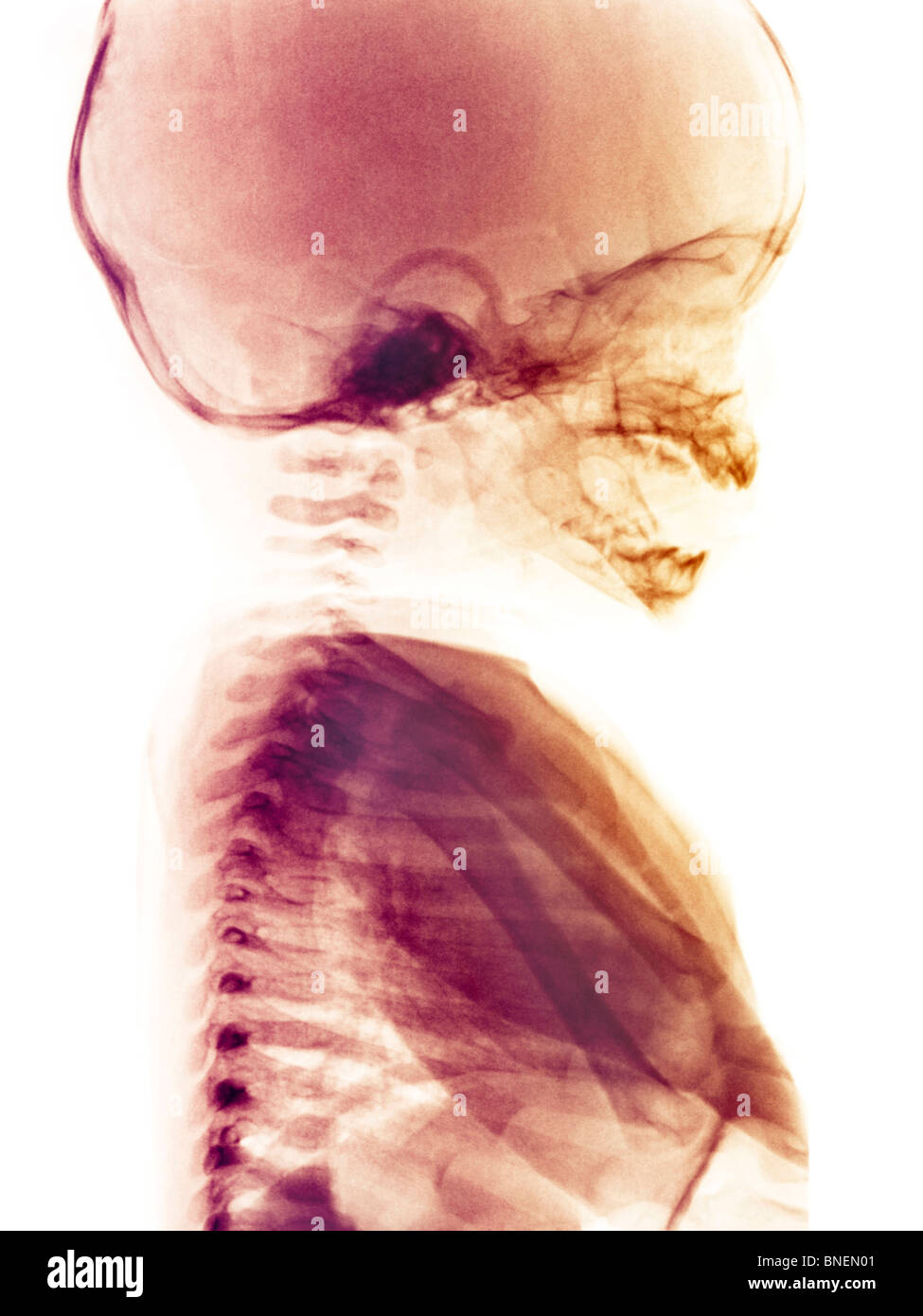 Röntgenbild eines 3 Monate alten Kopf und thorax Stockfoto