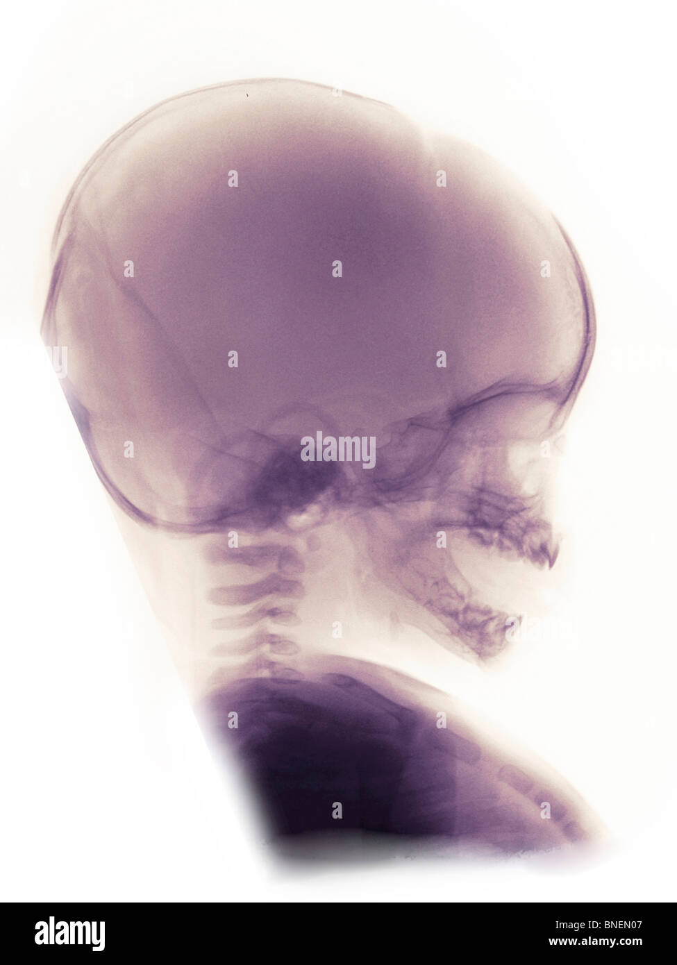 x-ray ein 3 Monate altes Mädchen Totenkopf Stockfoto