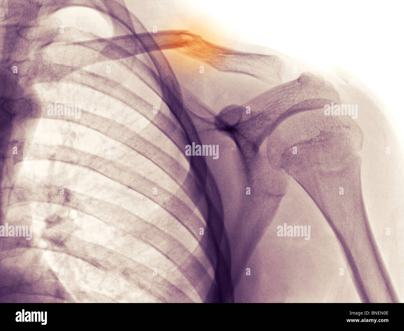 Schulter Röntgen zeigt gebrochenen Schlüsselbein Stockfoto