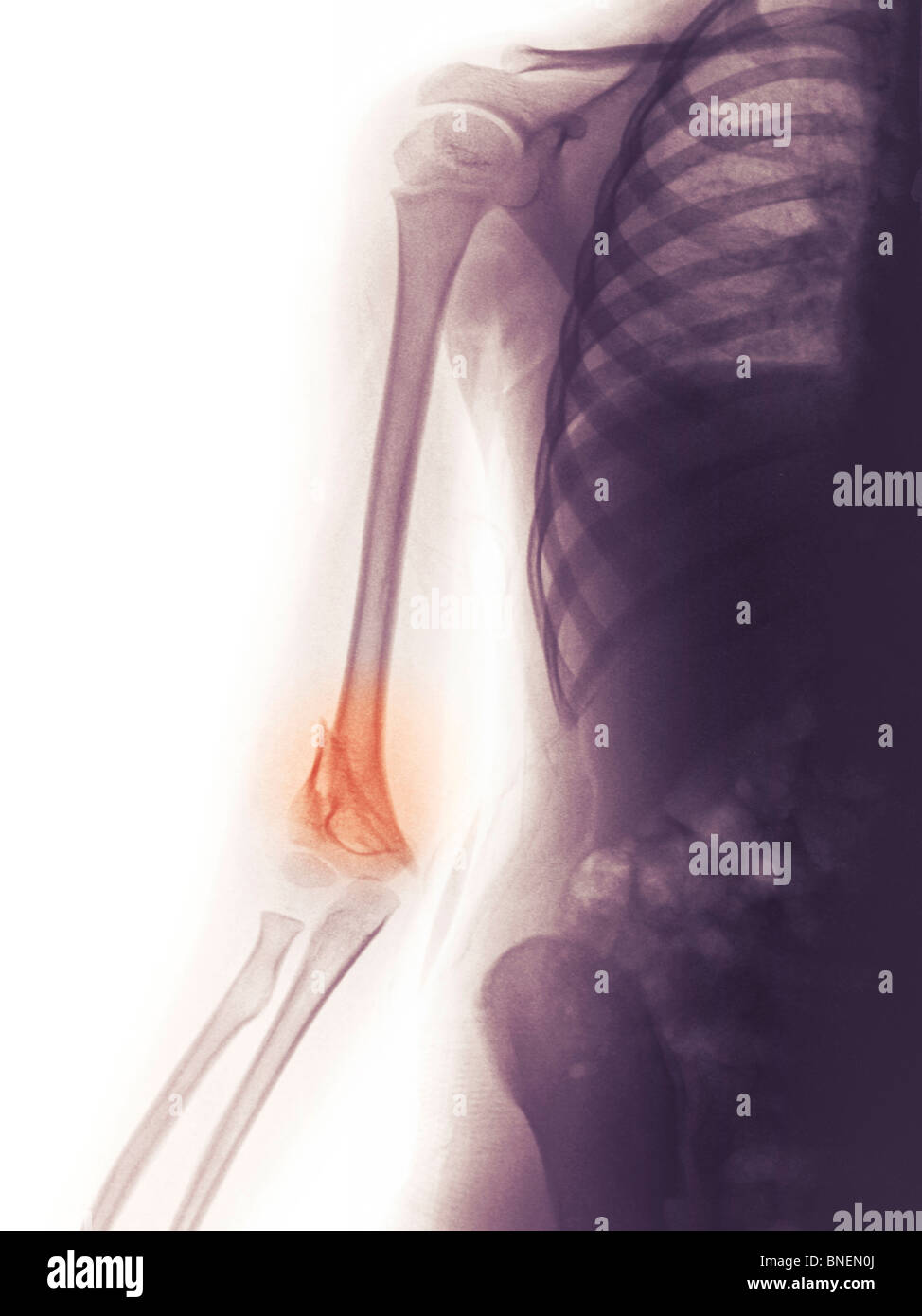 Röntgenbild eines gebrochenen distalen humerus Stockfoto