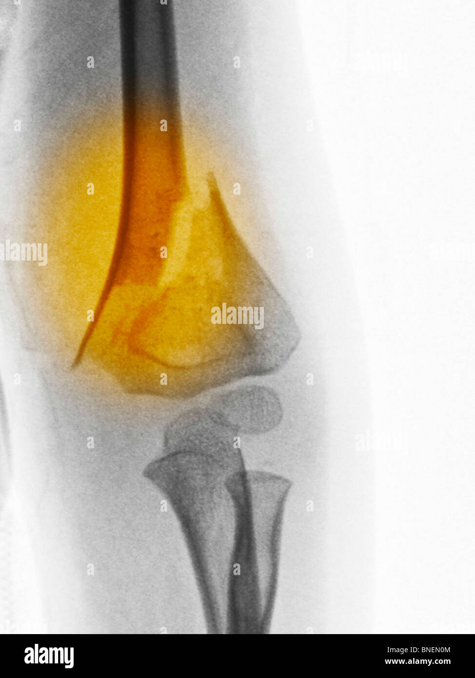 Röntgenbild einer Fraktur des distalen humerus Stockfoto