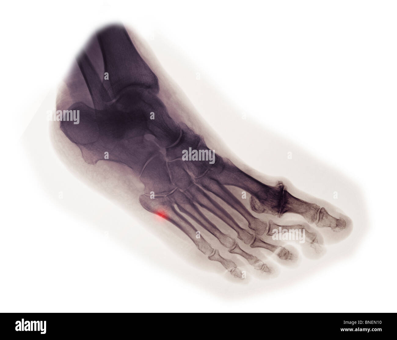 Fuß Röntgen zeigt gebrochenen 5. Mittelfußknochen Stockfoto