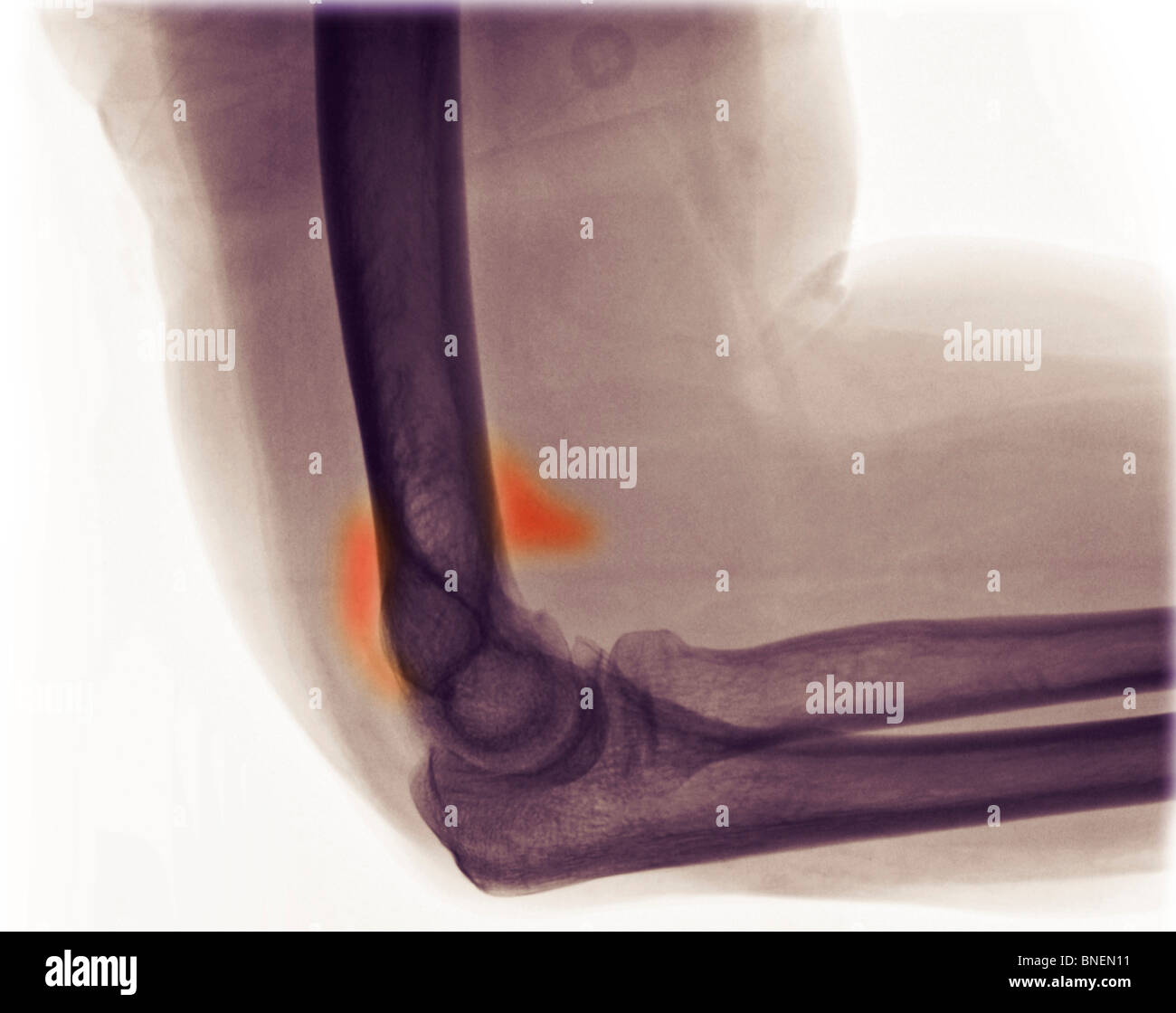 Ellbogen Sie x-ray zeigt eine okkulte Fraktur Stockfoto