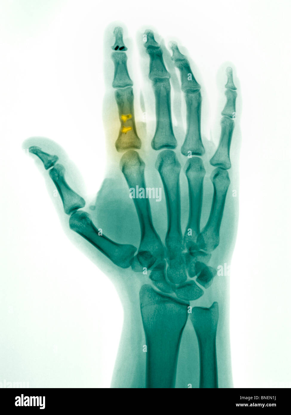 X-ray zeigt Flexor Tendon Reparatur des Zeigefingers Stockfoto