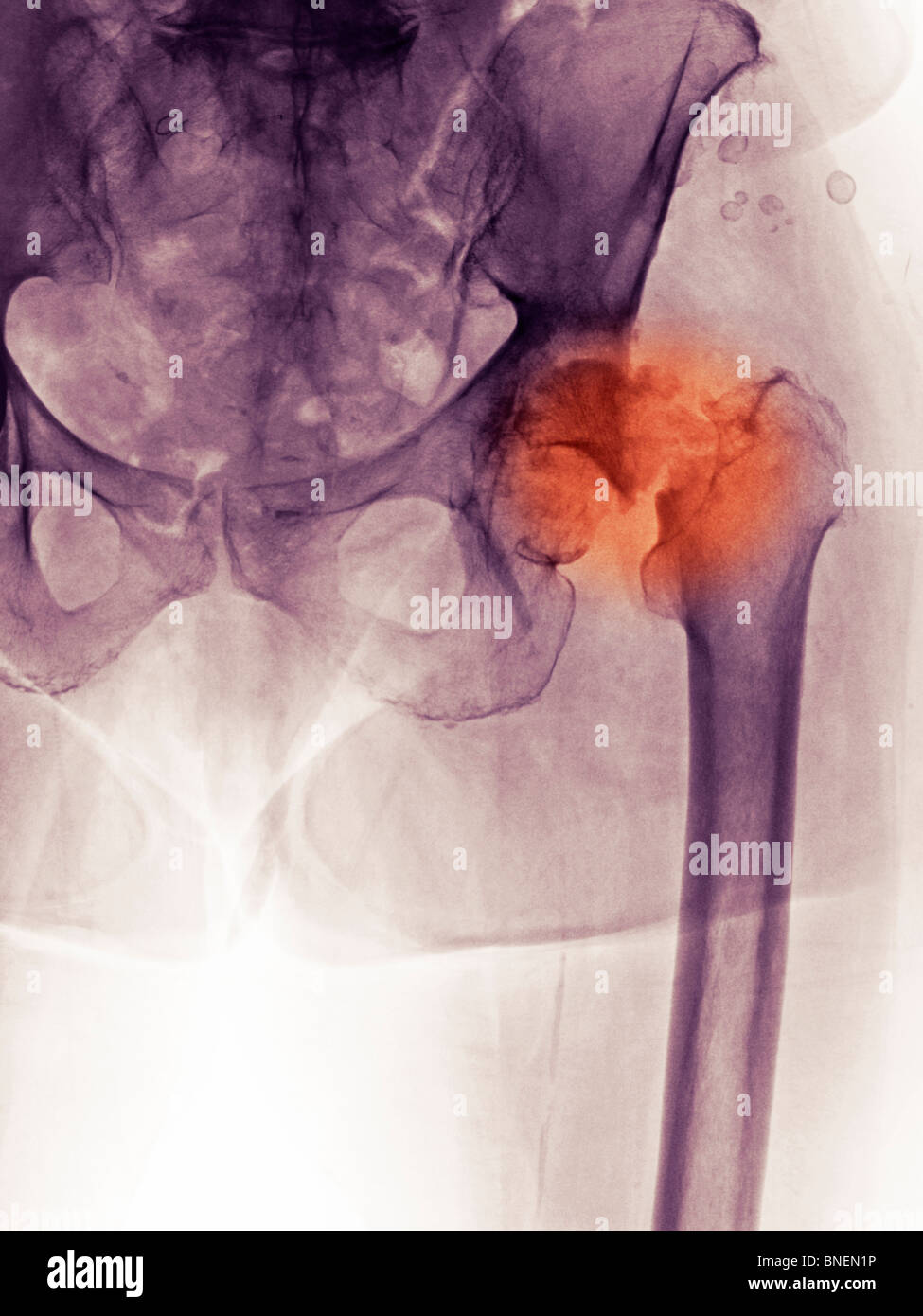 Röntgenbild einer Hüftfraktur und Degenerative Gelenkerkrankung Stockfoto