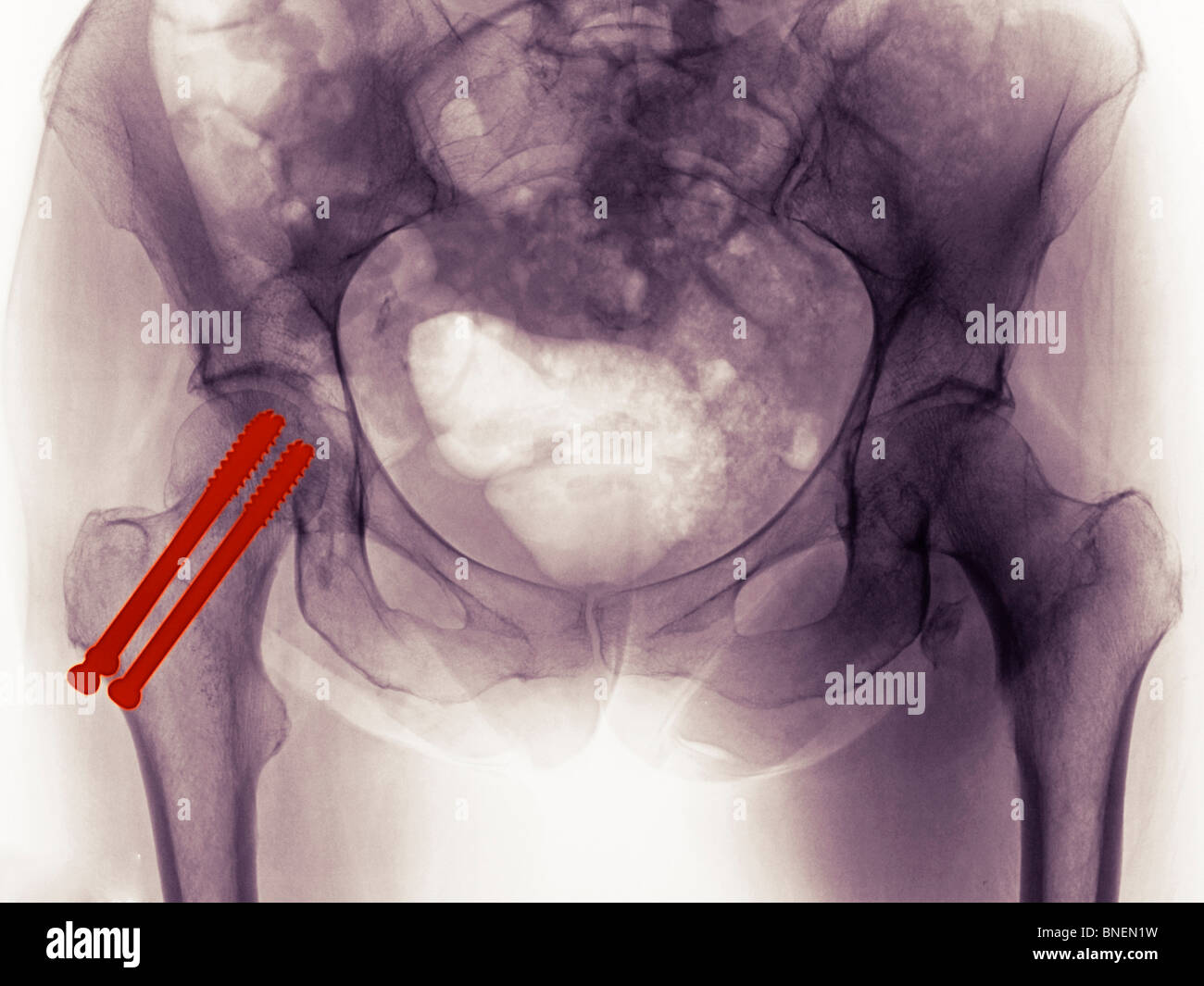 Becken-Röntgen zeigt die Reparatur von Hüftfrakturen mit 2 Schrauben Stockfoto