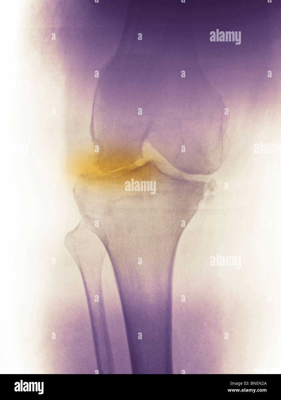 Knie Röntgen eine 60 Jahre alte Frau zeigt Degenerative Gelenkerkrankung Stockfoto