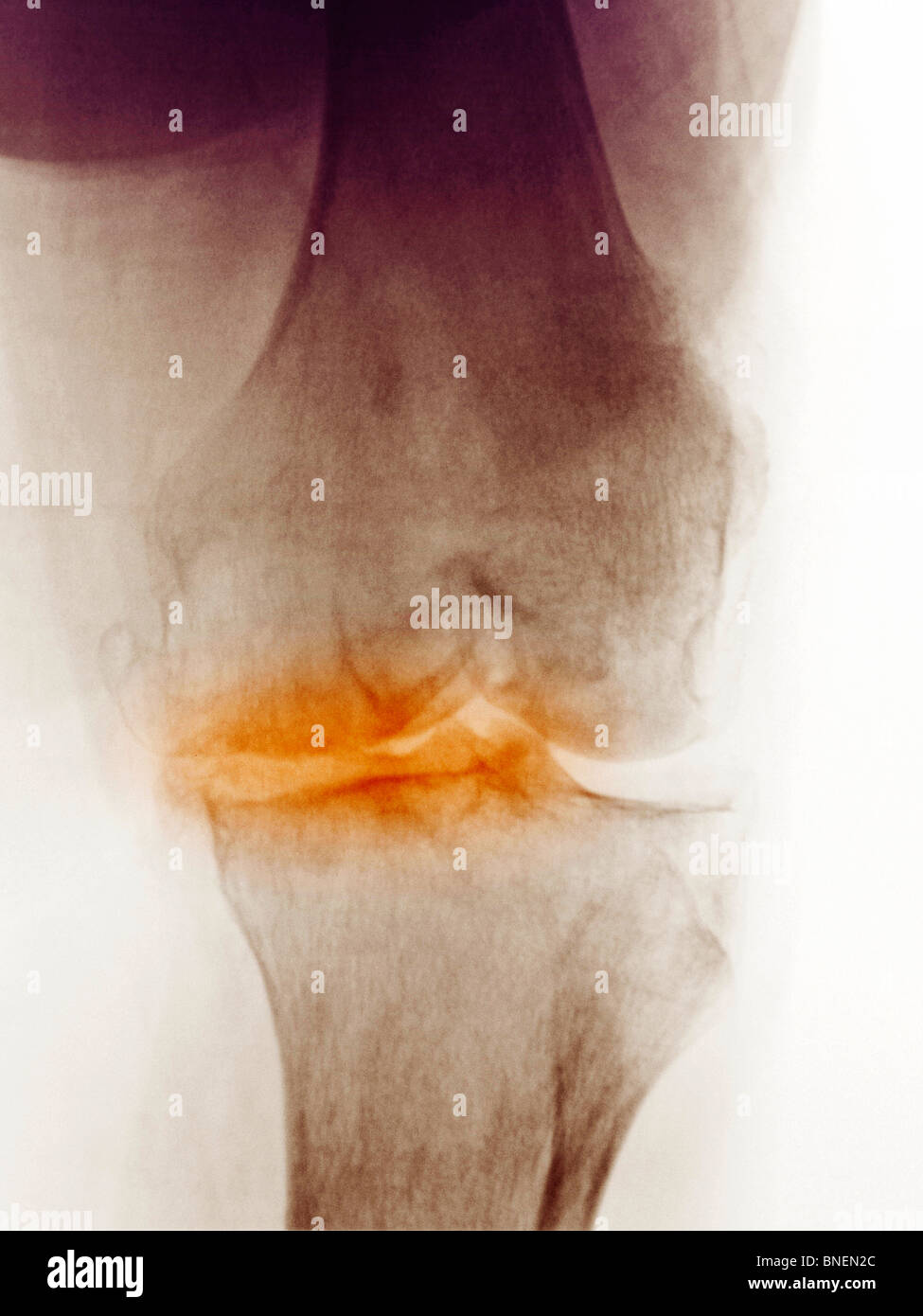 Röntgen des Knies eine 83 Jahre alte Frau, die Arthrose. Stockfoto