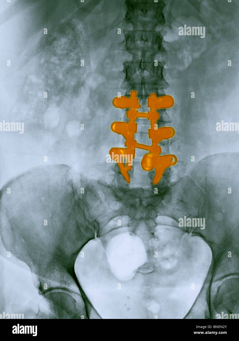 Lendenwirbelsäule zurück x-ray eine 55 Jahre alte Frau, die eine Spondylodese Stockfoto