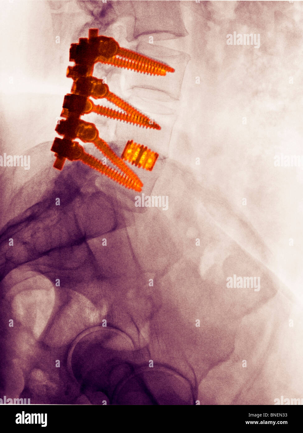 Lendenwirbelsäule zurück x-ray eine 55 Jahre alte Frau, die eine Spondylodese Stockfoto