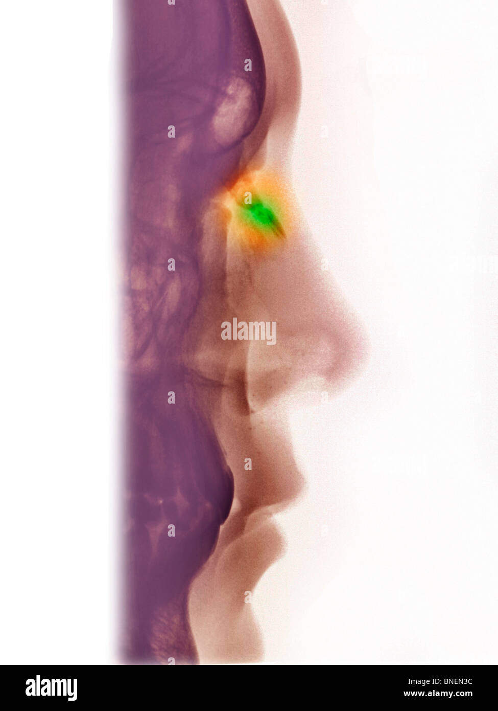 Röntgen der nasale Knochen zeigen eine Fraktur Stockfoto