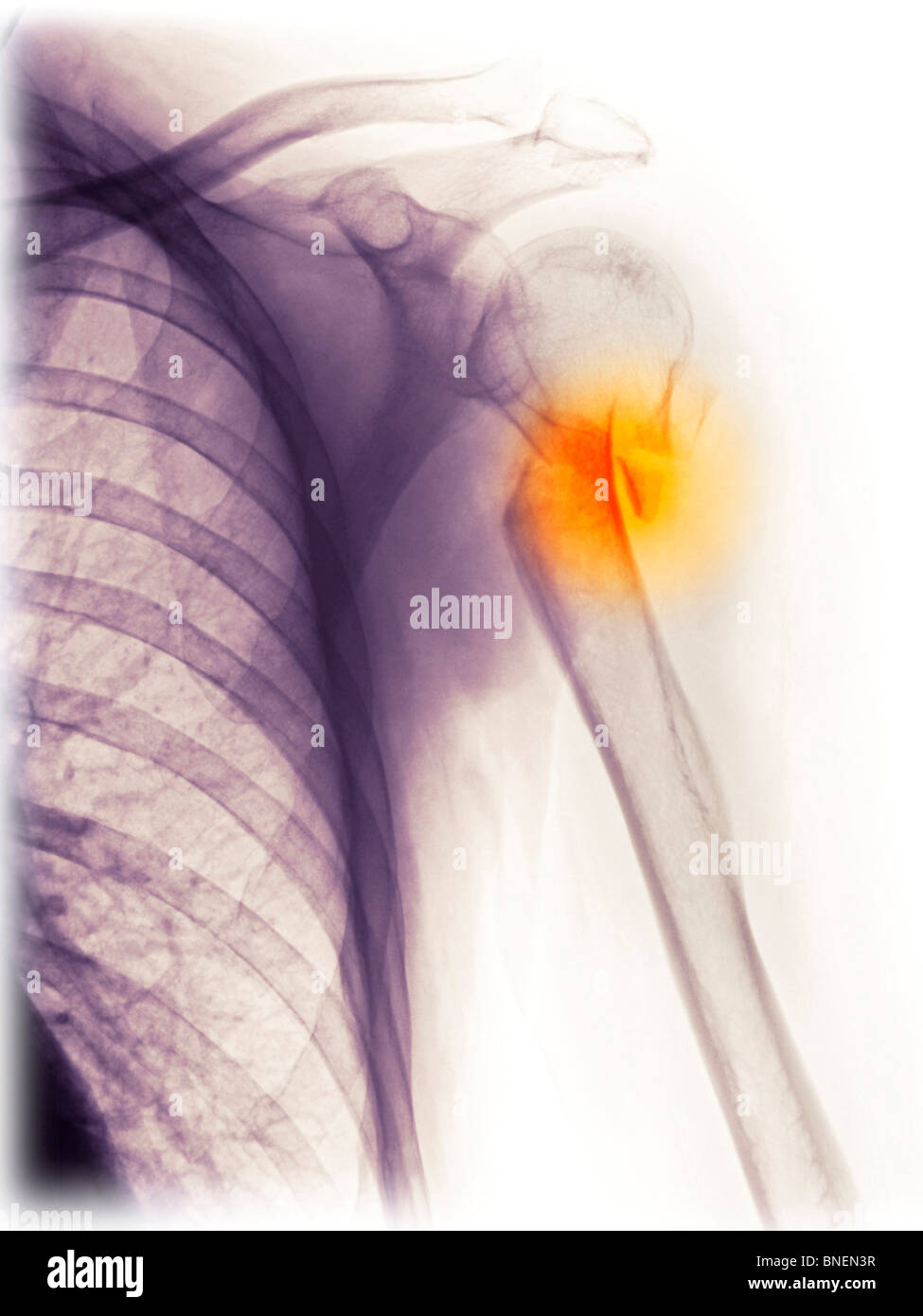 Röntgen der Schulter zeigt gebrochenen Oberarmknochen. Stockfoto