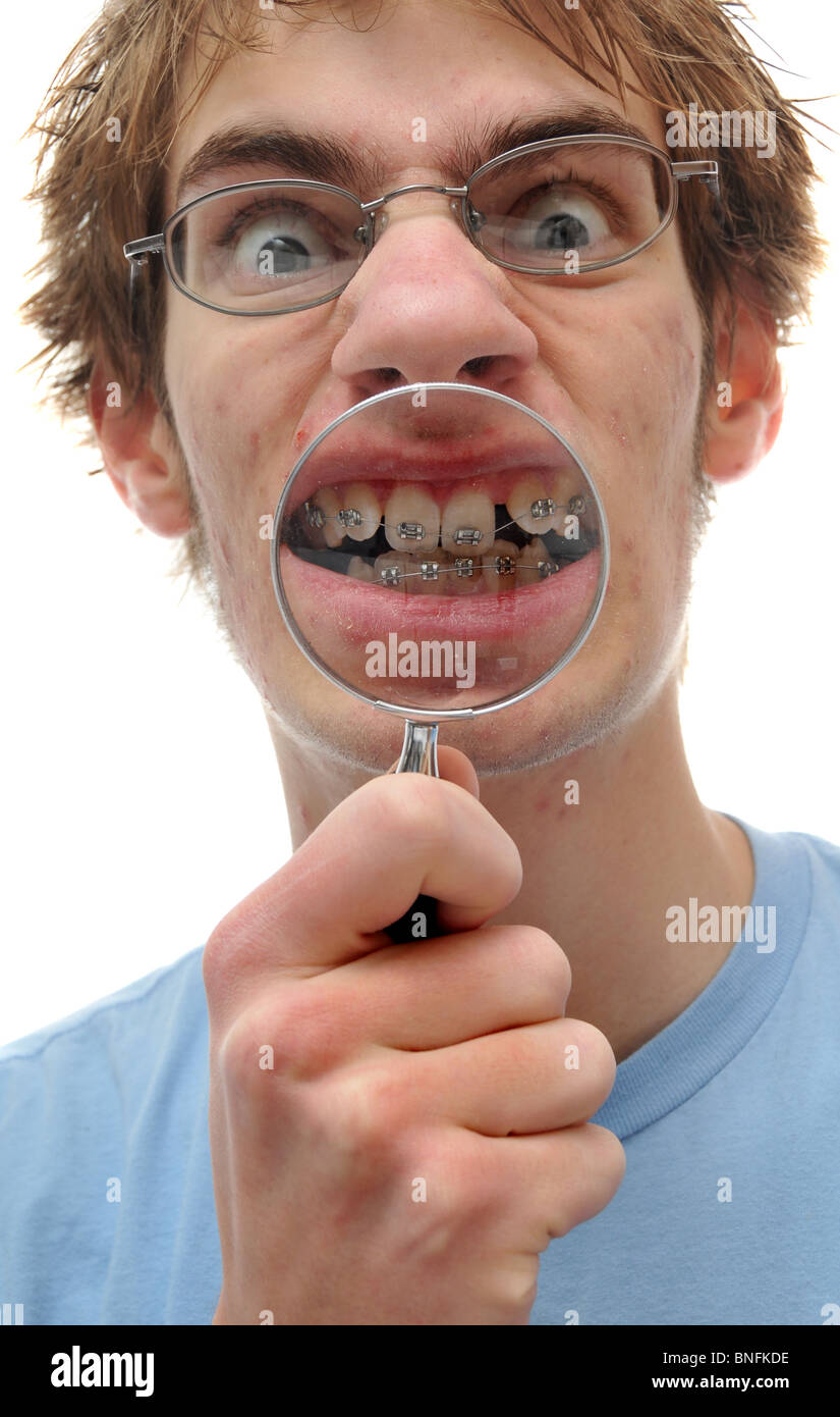 Ein junger Erwachsener hält eine Lupe bis zu seinem schiefen Zähnen mit Klammern auf. Stockfoto