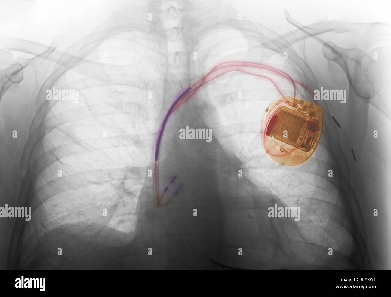 Röntgen-Thorax zeigt eine implantierte Herzschrittmacher Stockfoto