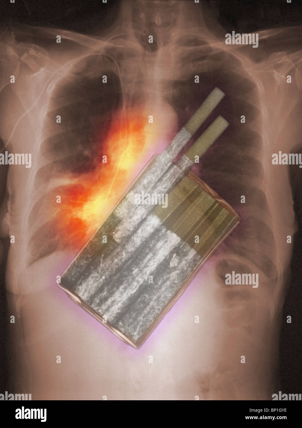 Abbildung der Röntgenaufnahme eine Packung Zigaretten eine Brust Röntgen zeigt Lungenkrebs überlagert Stockfoto