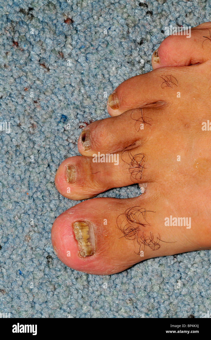 Pilzartige Infektion. Blick auf die gebrochen, verfärbte und schlecht wachsenden Fußnägel mit Pilz (Tinea Unguium) infiziert Stockfoto