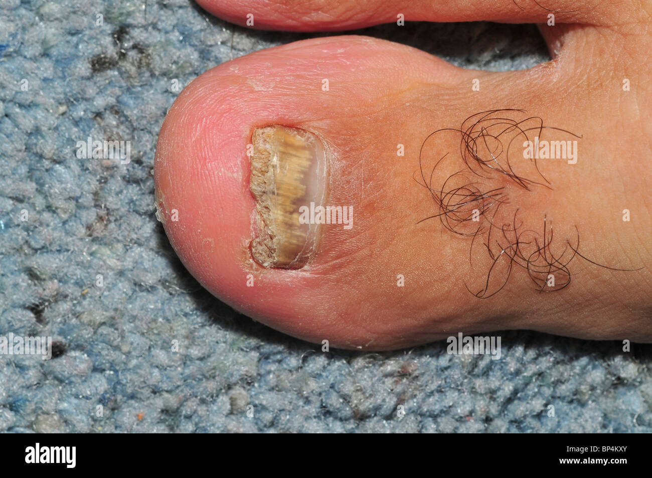Pilzartige Infektion. Blick auf die gebrochen, verfärbte und schlecht wachsenden Fußnägel mit Pilz (Tinea Unguium) infiziert Stockfoto