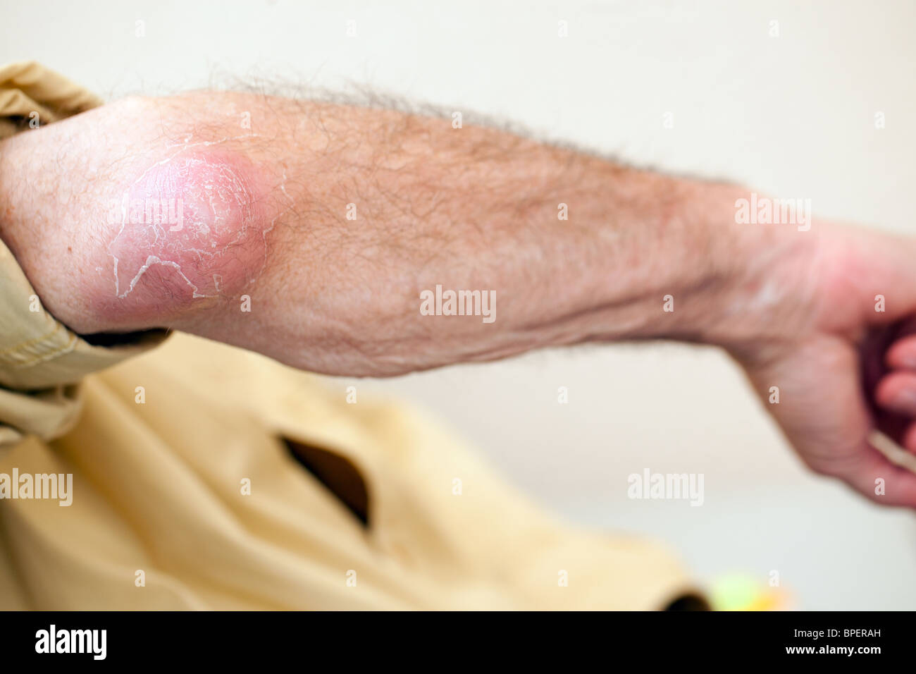 trockene Haut am Ellenbogen senior woman Stockfoto