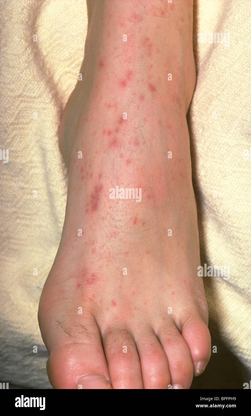 Fuß eines Patienten infiziert mit dem Bakterium Neisseria Meningitidis, Hauttumoren und Blutungen unter der Haut Stockfoto