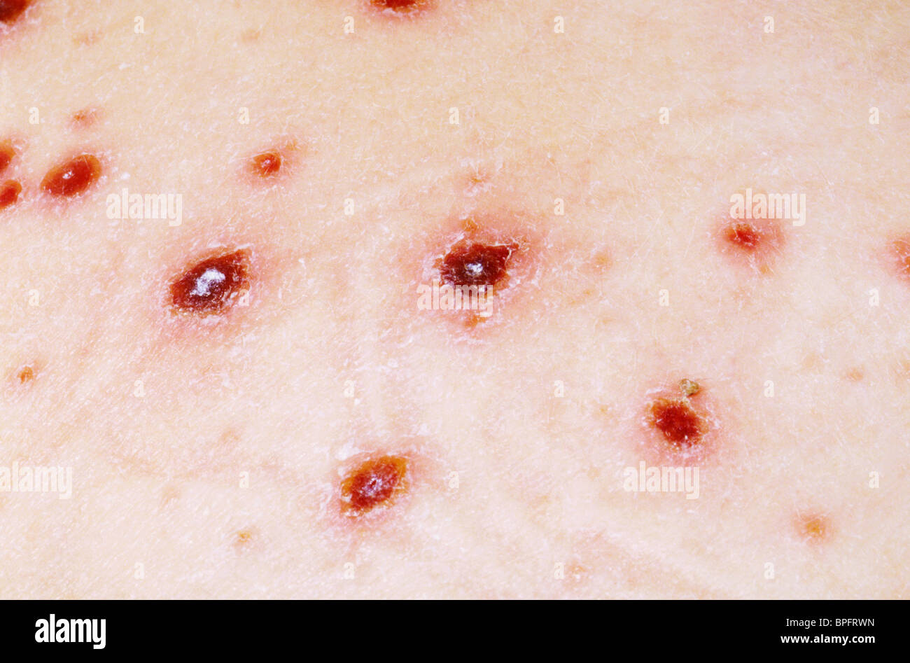 Ein Bild von eine hochinfektiöse Krankheit, die durch Varizellen, ein Herpesvirus verursacht. Stockfoto