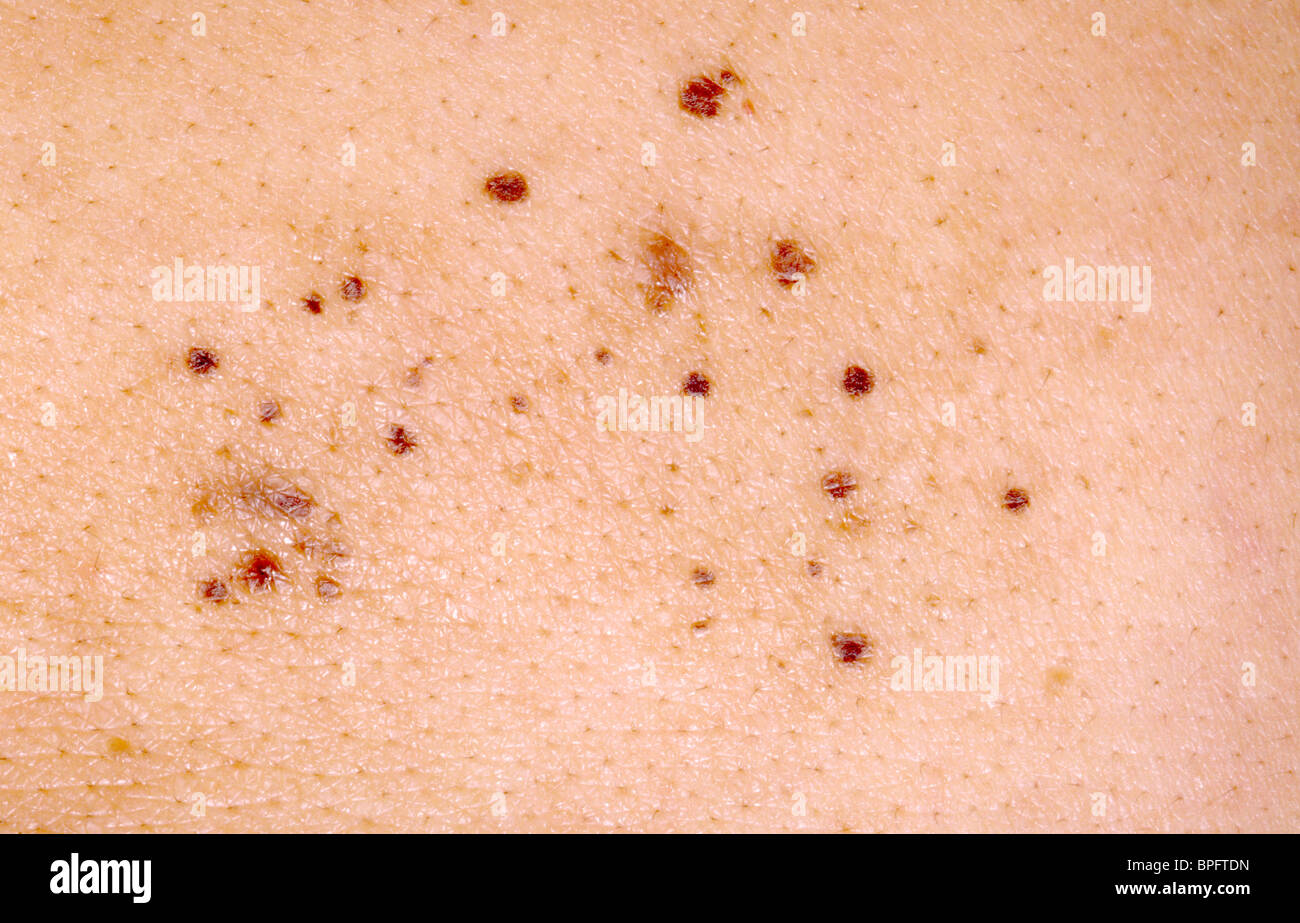 Ein Bild von mehreren flachen braunen Flecken auf der Haut bemerkt in der Regel kurz nach der Geburt. Stockfoto