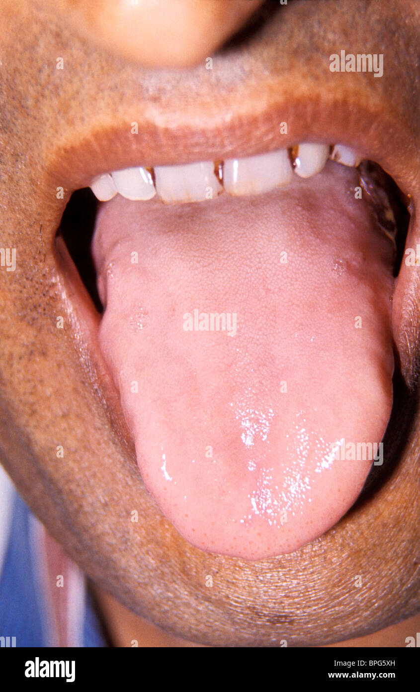 Männchen mit Vitamin B12-Mangel Stockfoto