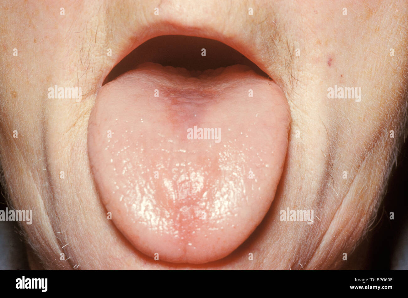 Männchen mit Vitamin B12-Mangel Stockfoto