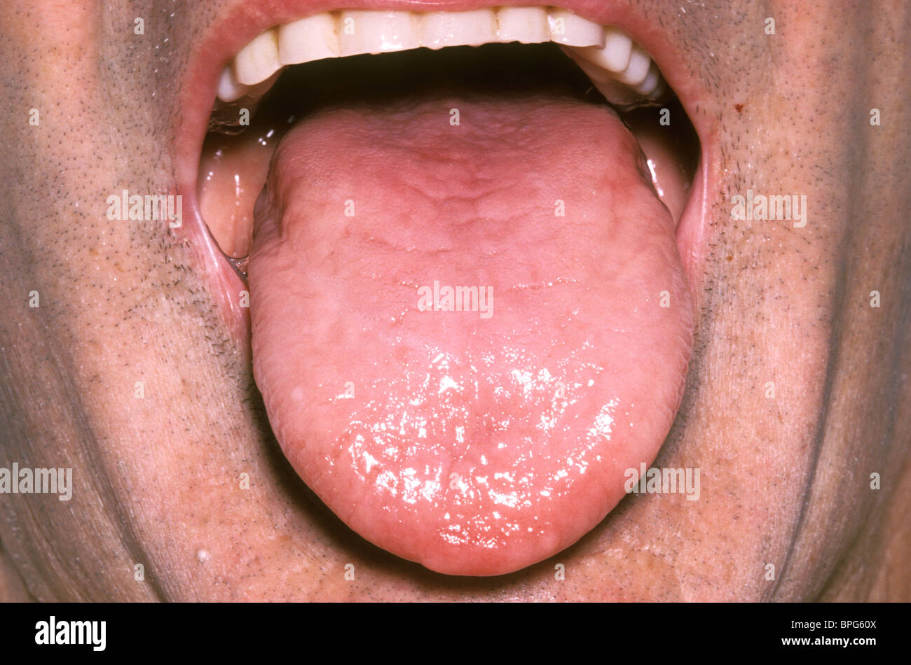 Ein Mann mit Vitamin B12-Mangel Stockfoto