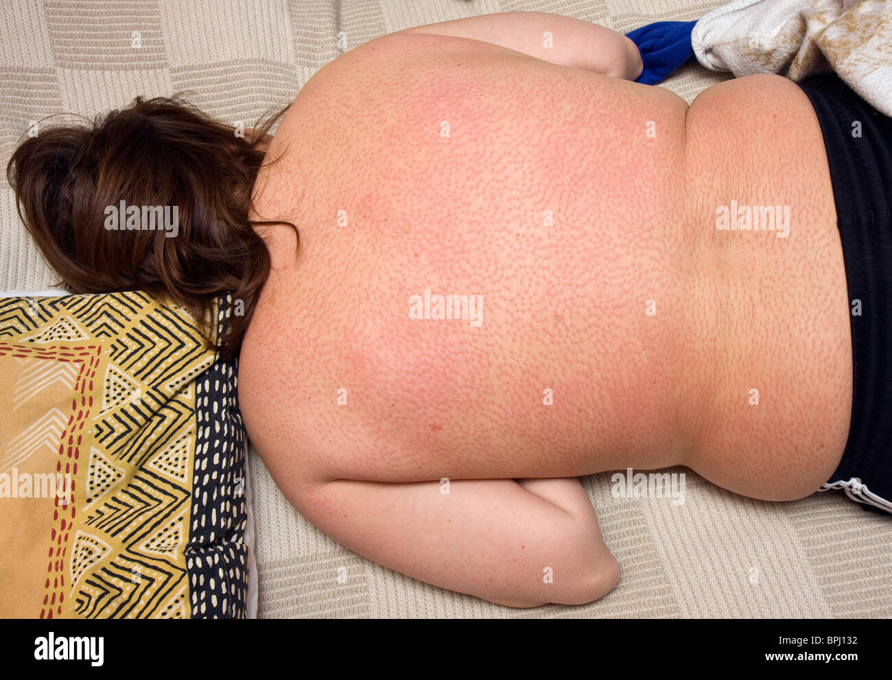 Rote Flecken auf dem Rücken einer Frau nach liegend auf einer Matte Nagel. Stockfoto