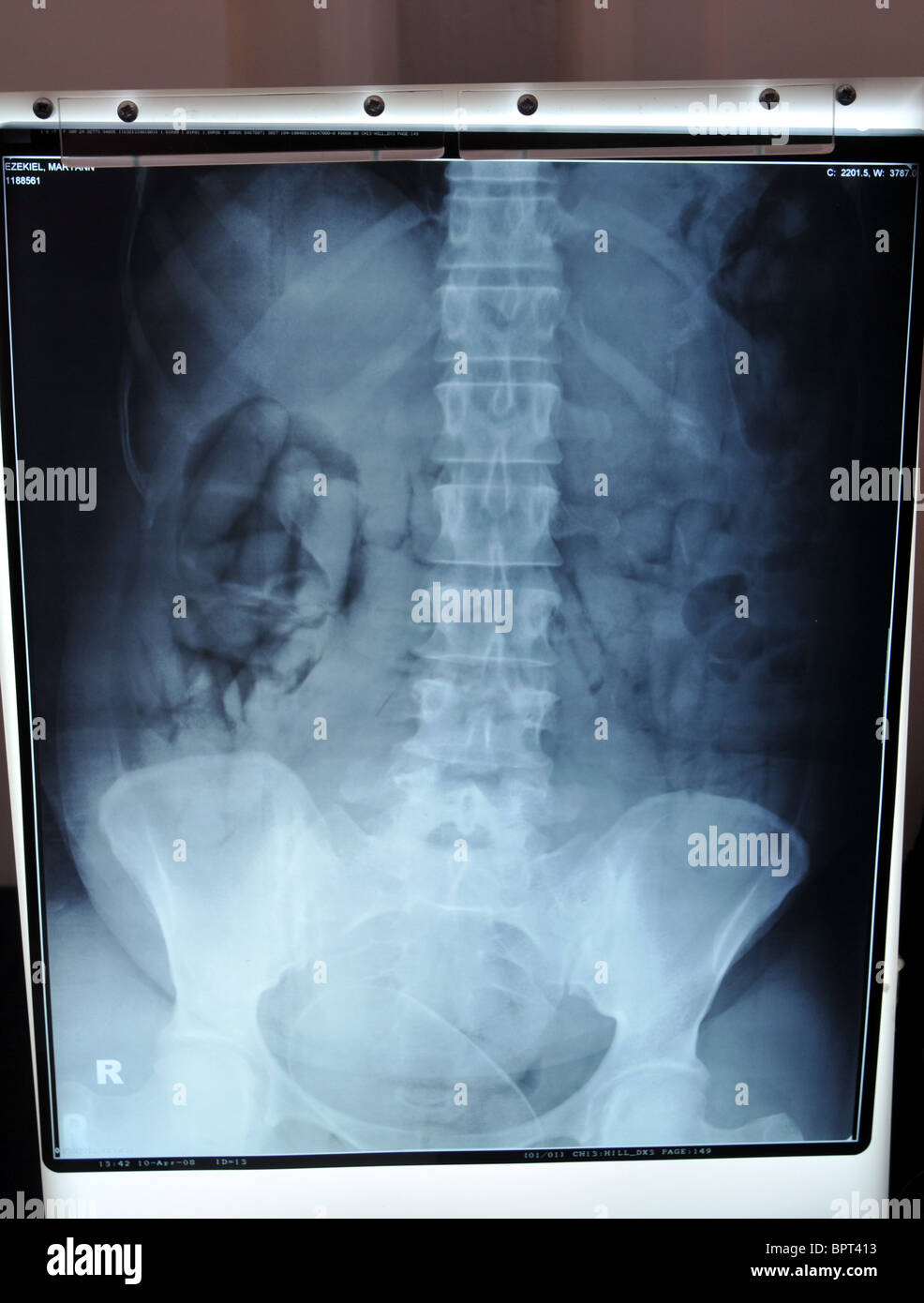 Sicherstellungen von Drogen Schmuggel von der UK Border Agency. X-ray zeigt mit Klebeband-Pakete, die von einem Drogenschmuggler verschluckt wurden Stockfoto