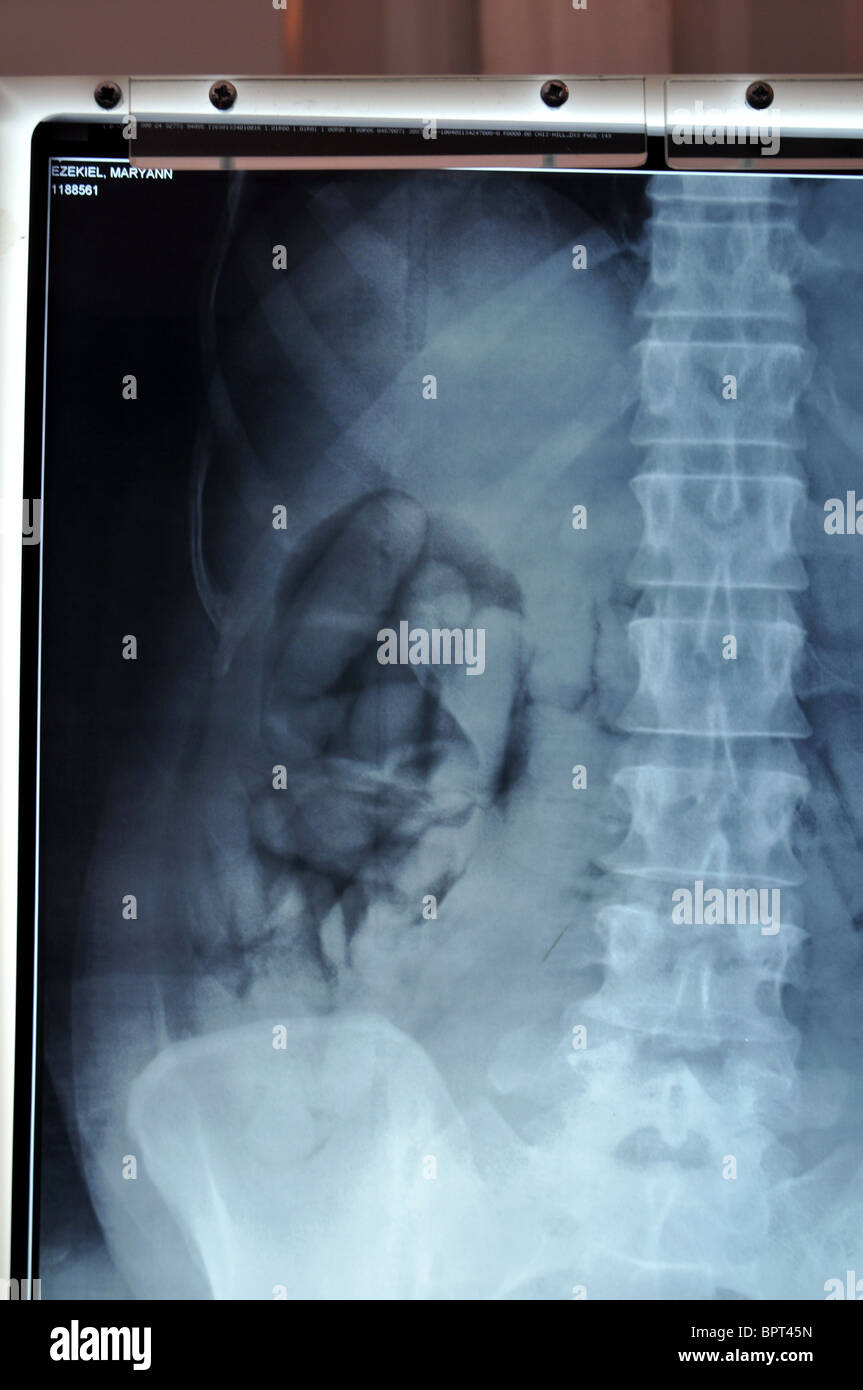 Sicherstellungen von Drogen Schmuggel von der UK Border Agency. X-ray zeigt mit Klebeband-Pakete, die von einem Drogenschmuggler verschluckt wurden Stockfoto