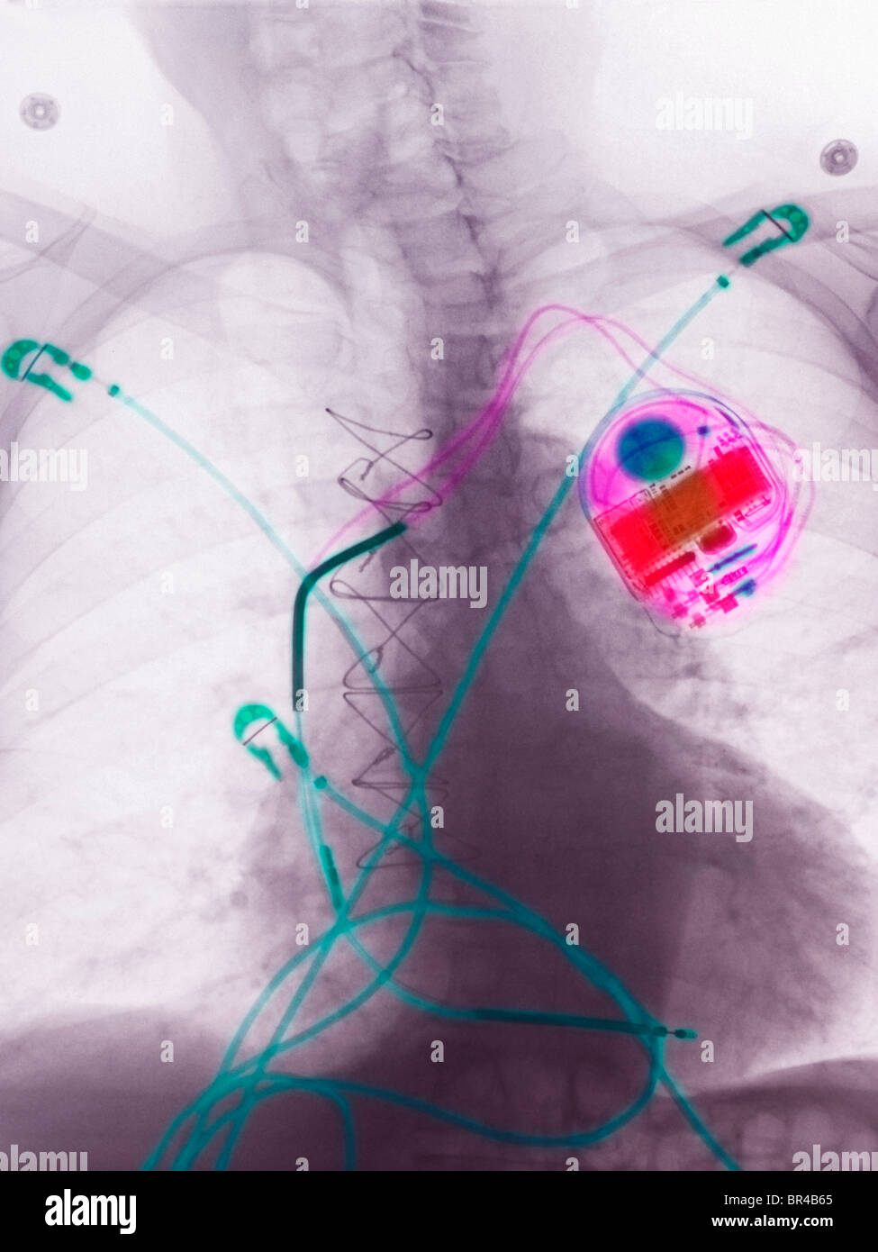 Röntgenaufnahme eines 80 Jahre alten Mannes zeigen kardiale Überwachung führt, eine Brust Herzschrittmacher und chirurgische Drähte von einer Herzoperation Stockfoto