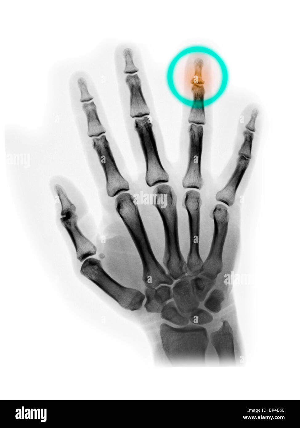 Hand Röntgen einen 40 Jahre alten Mannes, der seinen Ringfinger mit einem Hammer getroffen und brach seine distalen Phalanx (Fingertip) Stockfoto