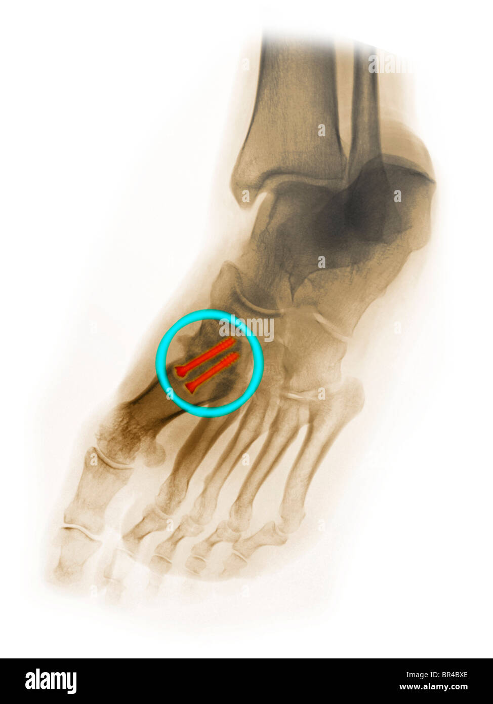 Fuß Röntgen einen 30 Jahre alten Mannes, der mit 2 Schrauben, die Absicherung der Mittelfußknochen, die Fußwurzelknochen des ersten Mittelfußknochens operiert Stockfoto