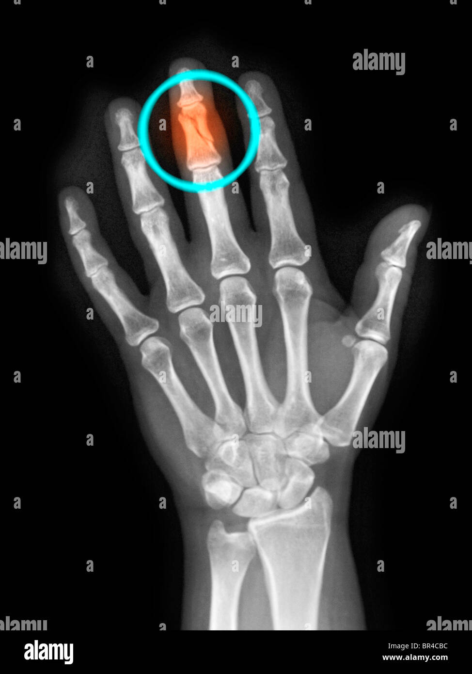 Röntgen der Hand eine 40 Jahre alte Frau, die ein gebrochener Mittelfinger Stockfoto