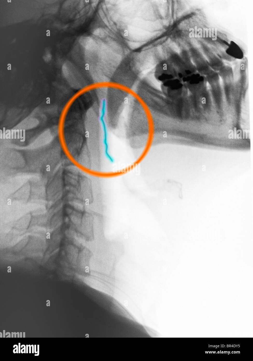 seitliche Röntgenaufnahme des Halses eines 39 Jahre alten psychiatrischen Patienten, die eine aufgebogene Büroklammer geschluckt, er entfaltet Stockfoto