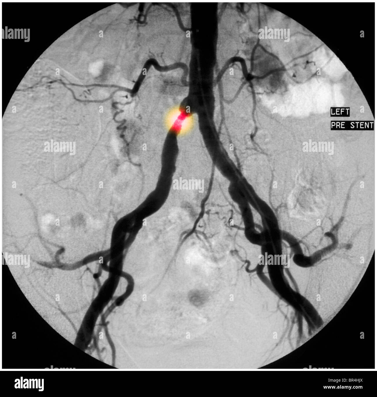 Angiogramm ein 65-jähriger Mann zeigt eine Fläche von Stenose in der gemeinsamen Beckenkamm Arterie Stockfoto