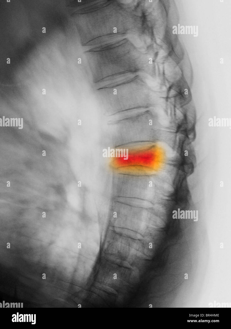 dorsale Wirbelsäule Röntgen in Seitenansicht zeigt eine Kompressionsfraktur T7 in ein 77 Jahre alter Mann Stockfoto