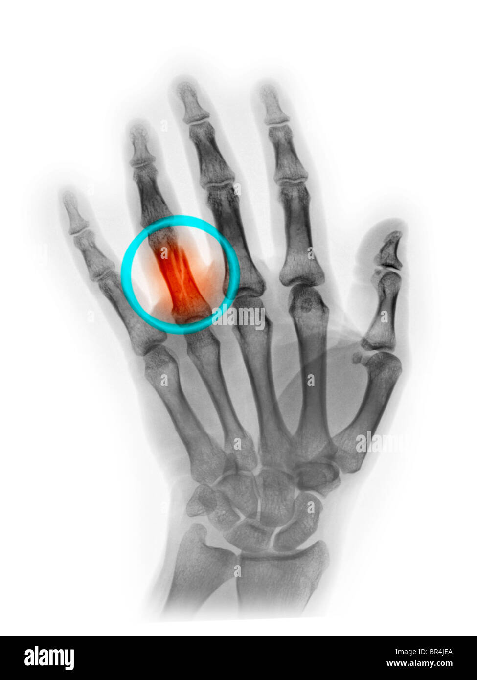 Gebrochener Finger Stockfotos und bilder Kaufen Alamy