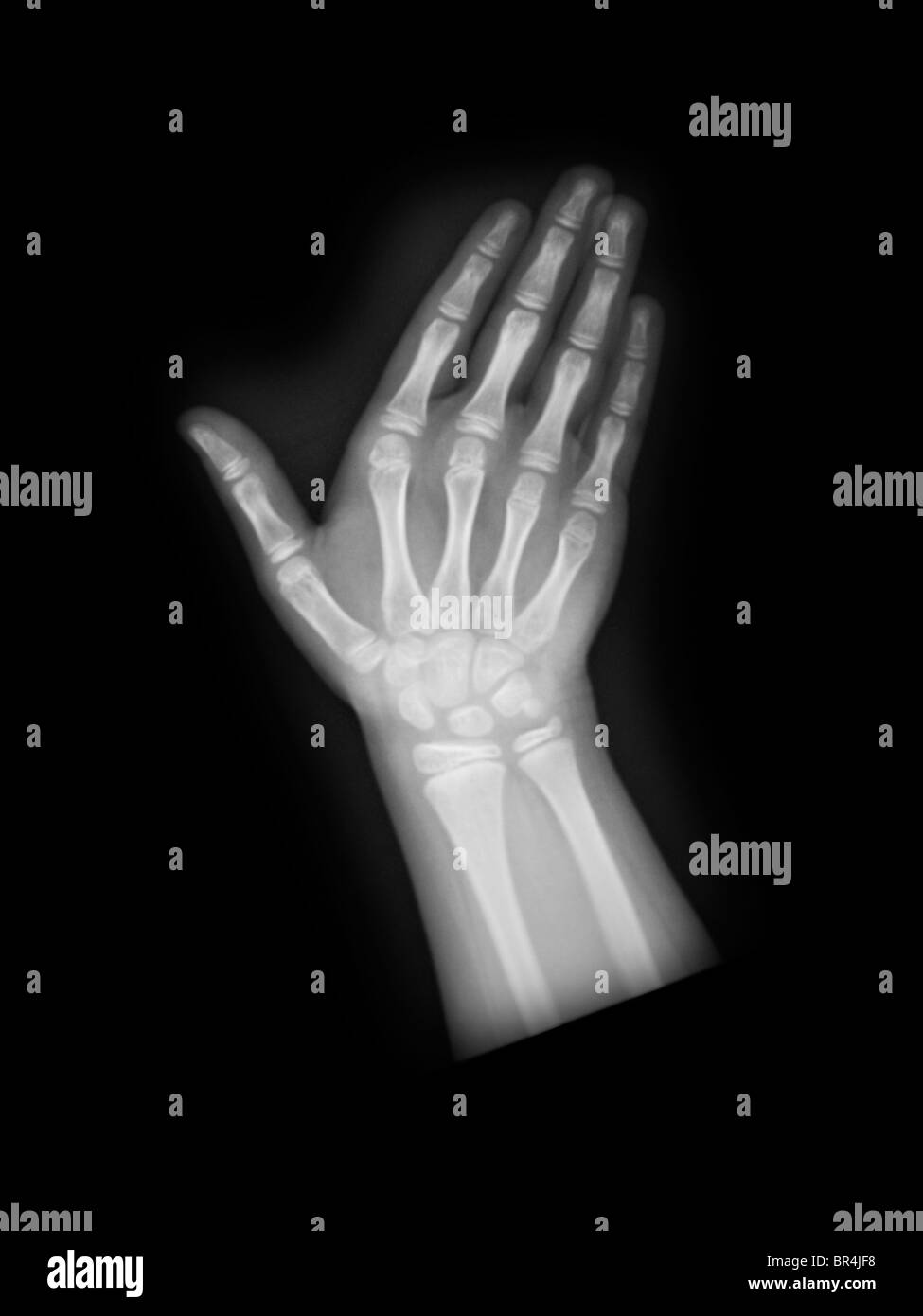 x-ray, der die Hand von einer 8-jährigen Stockfoto