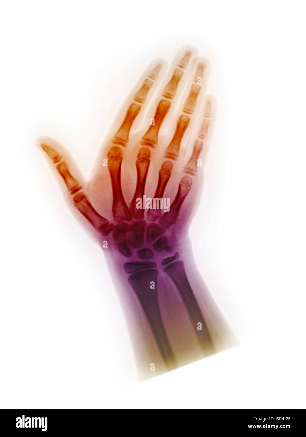 x-ray, der die Hand geröntgt 8 Jahre alt, normale Hand eines 8-jährigen Mädchen Stockfoto